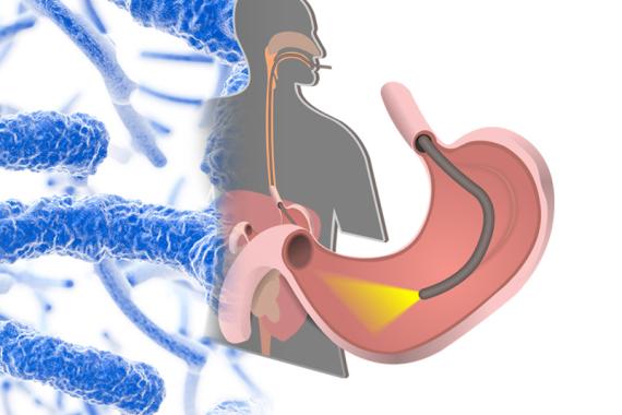 A depiction of how a duodenoscope works. The graphic shows the scope lighting the inside of the stomach
