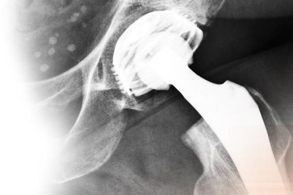 An black and white X-ray of a metal hip in a metal hip socket