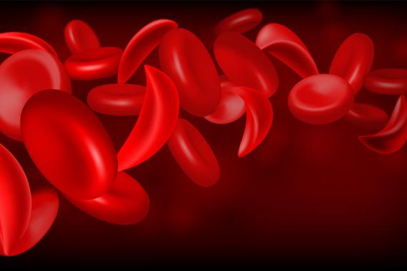 A depiction of red blood cells. Some of the cells are shaped like round disks and others are sickle cells and shaped like half-moons