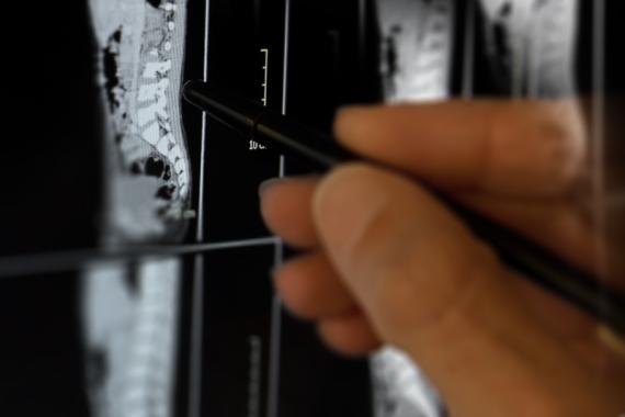 Personal Injury Lawsuits