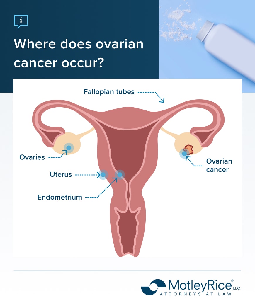 Female reproductive system showing endometrium, fallopian tubes, uterus, healthy ovaries on one side and ovarian cancer on the other.
